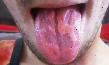 Мужчина сжег язык из-за одержимости энергетиками