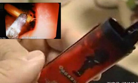 В Китае мужчина на спор проглотил зажигалку и едва избежал взрыва желудка