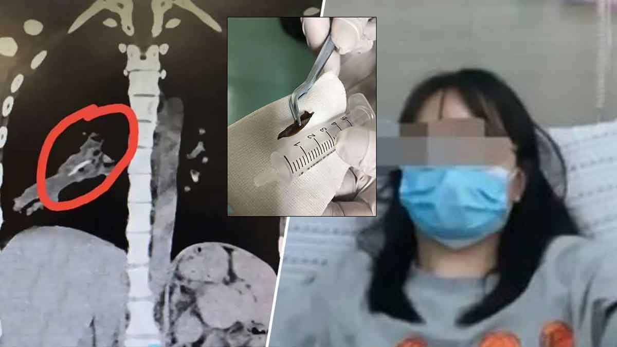 Китаянка 14 лет кашляла из-за кусочка курицы в легких