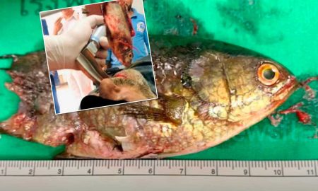 Рыба застрявшая в горле рыбака удивила врачей