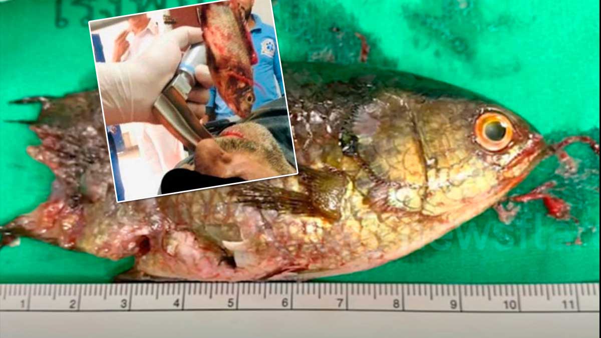 Рыба застрявшая в горле рыбака удивила врачей