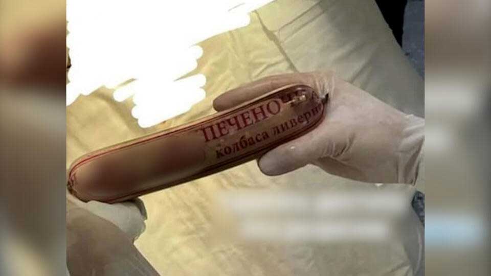 Ливерный «трофей»: врач похвастался как вытащил «без разрезов» из пациента палку колбасы